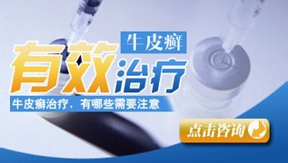 激素药对于牛皮癣治疗有哪些副作用