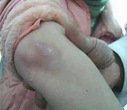 银屑病怎么治最好