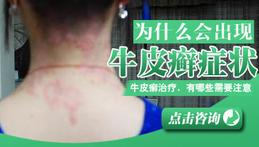 有哪些因素影响孩子银宵病的治疗