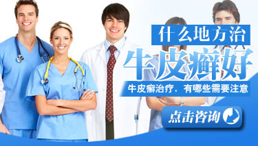 治疗牛皮癣需要注意哪些