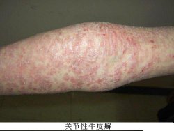 牛皮癣的表现症状