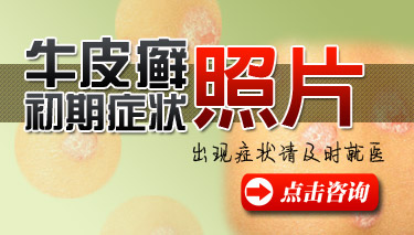 不同部位牛皮癣症状的表现
